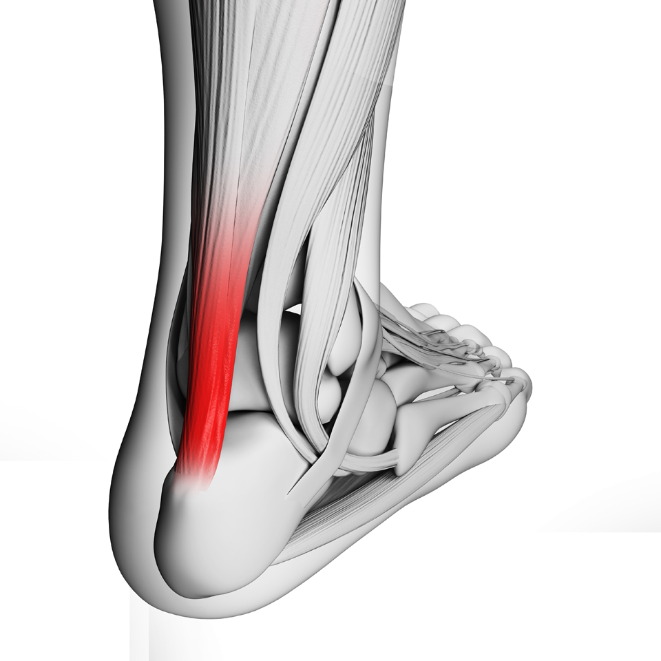 Inflamações e rupturas no Tendão de Aquiles: causas e como evitar | Clínica Orthop