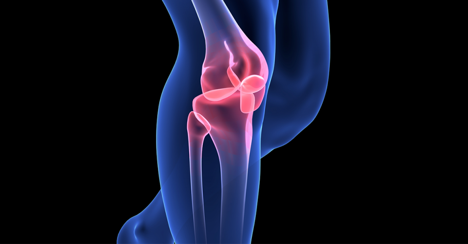 Artroplastia de joelho é uma das soluções para o tratamento de artrose